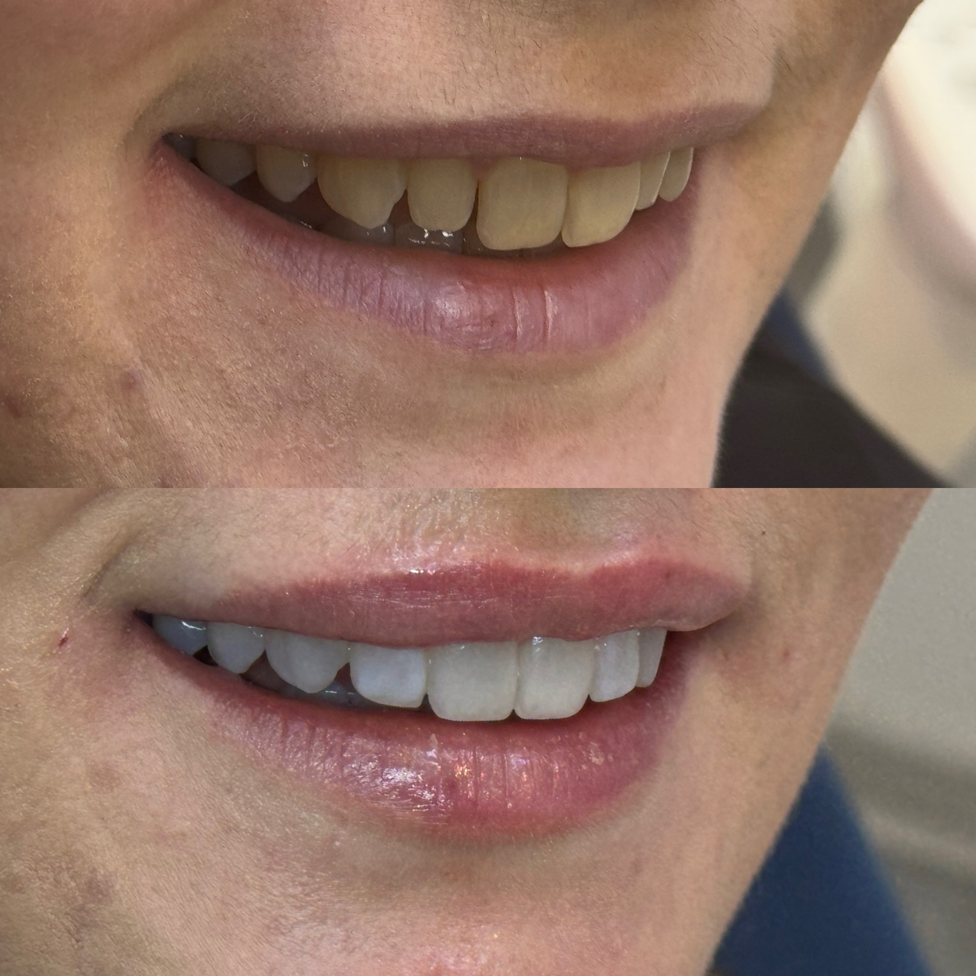 orthodontie par aligneurs pour incliner les dents vers l'avant, éclaircissement, 2 facettes composites sur les incisives latérales et augmentation des lèvres par acide hyaluronique
