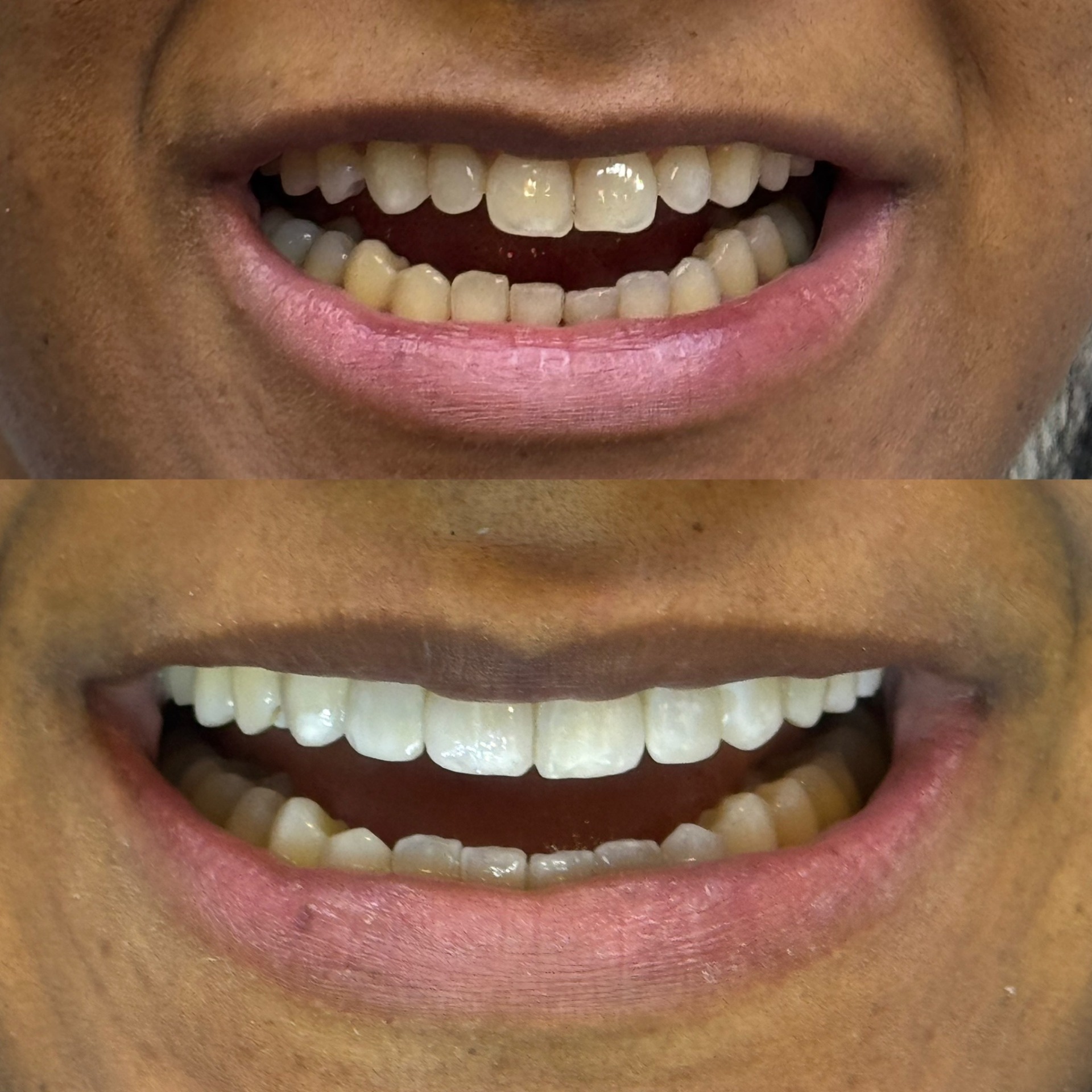 orthodontie par aligneurs, éclaircissement, facettes composites sur les incisives latérales et ajustements des bords des dents