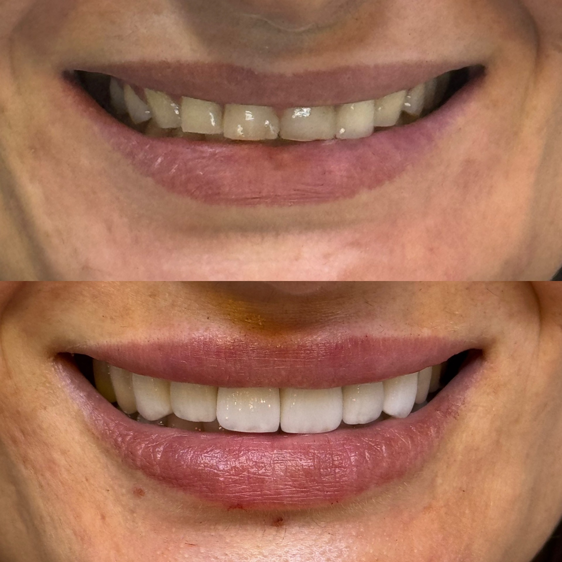 Augmentation de la hauteur dentaire par 8 overlays mandibulaires, éclaircissement, 6 facettes et augmentation du volume des lèvres